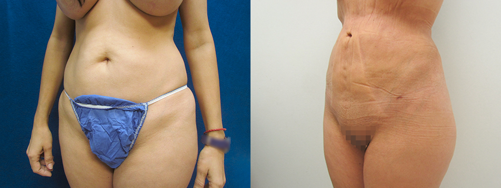 Liposuction before and after photos 
