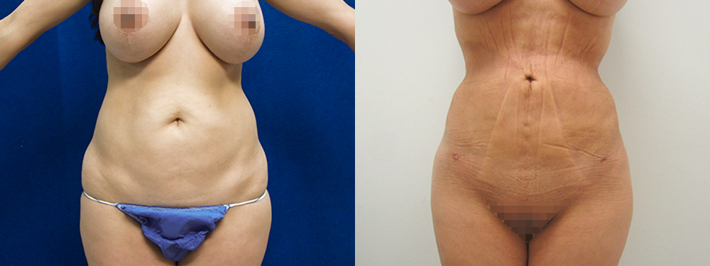 Liposuction before and after photos 
