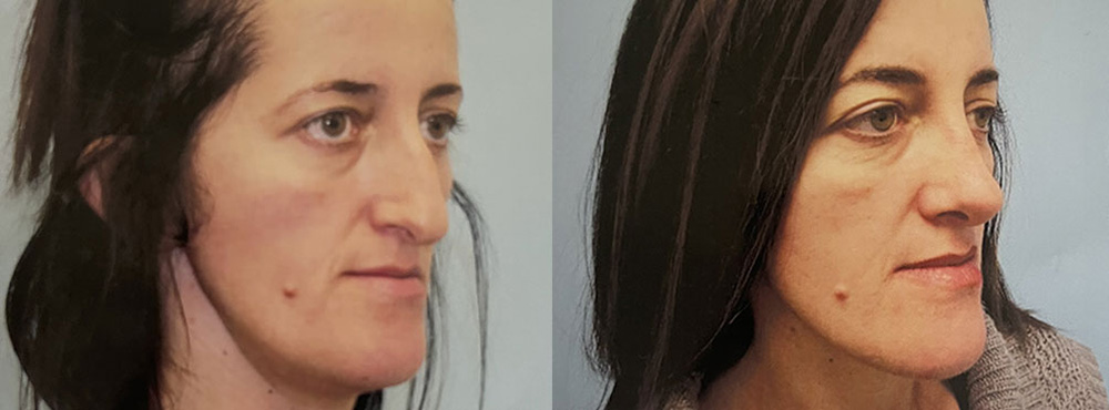 Rhinoplasty Before and After