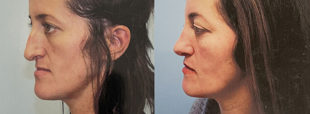 Rhinoplasty Before and After
