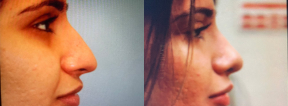 Rhinoplasty Before and After