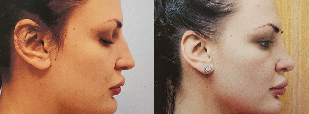 Rhinoplasty Before and After