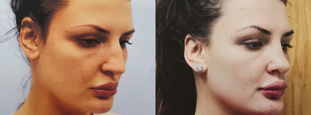 Rhinoplasty Before and After