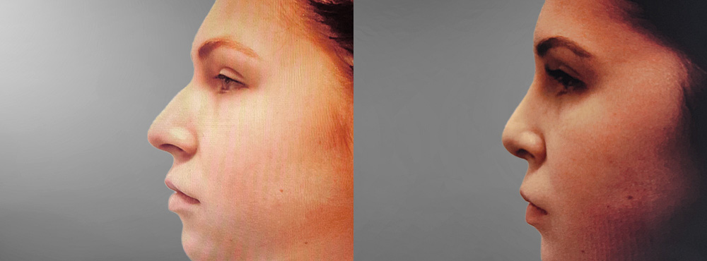 Rhinoplasty Before and After
