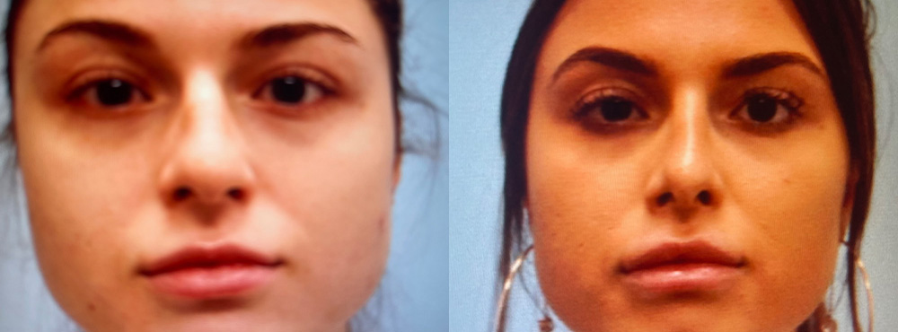 Rhinoplasty Before and After