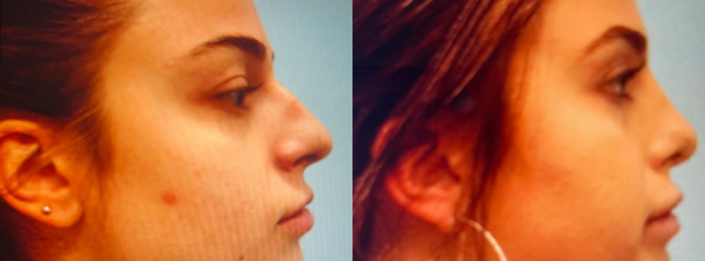 Rhinoplasty Before and After