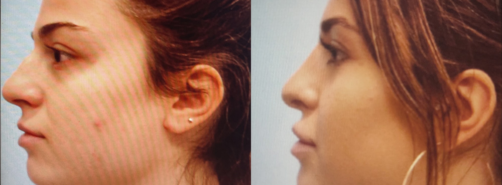 Rhinoplasty Before and After
