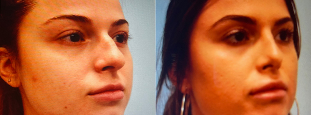 Rhinoplasty Before and After