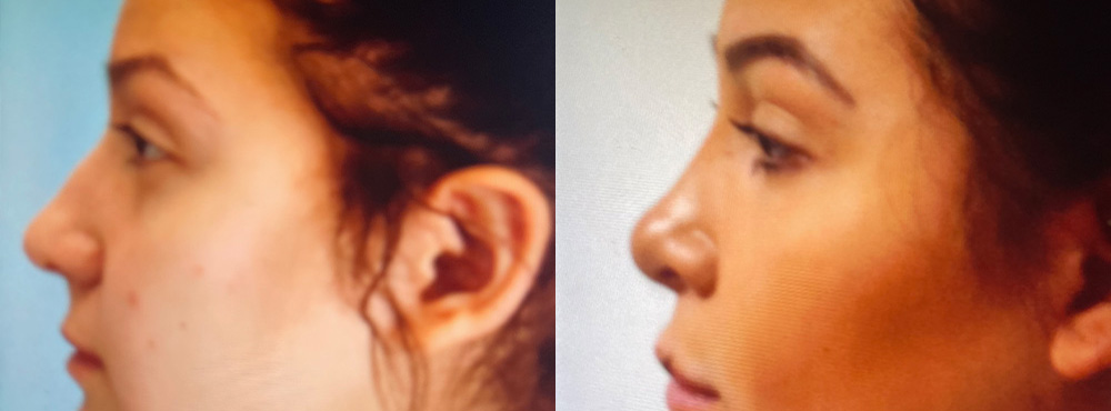 Rhinoplasty Before and After