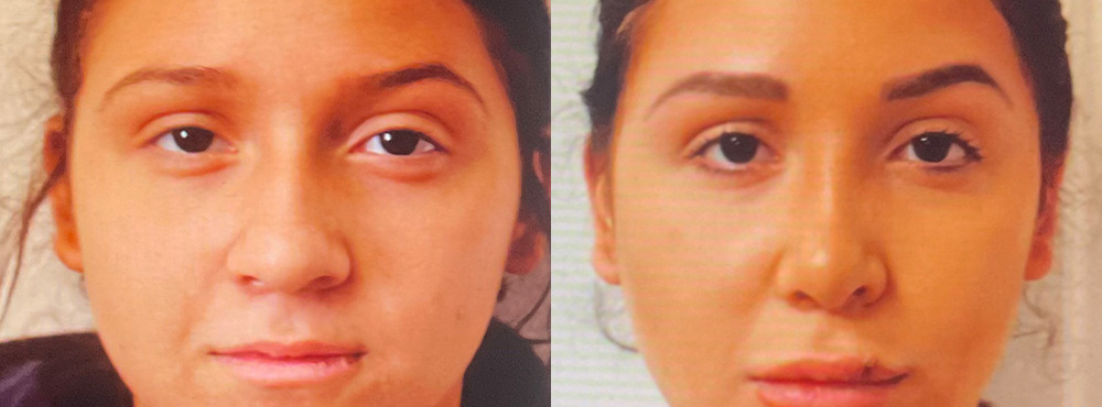 Rhinoplasty Before and After