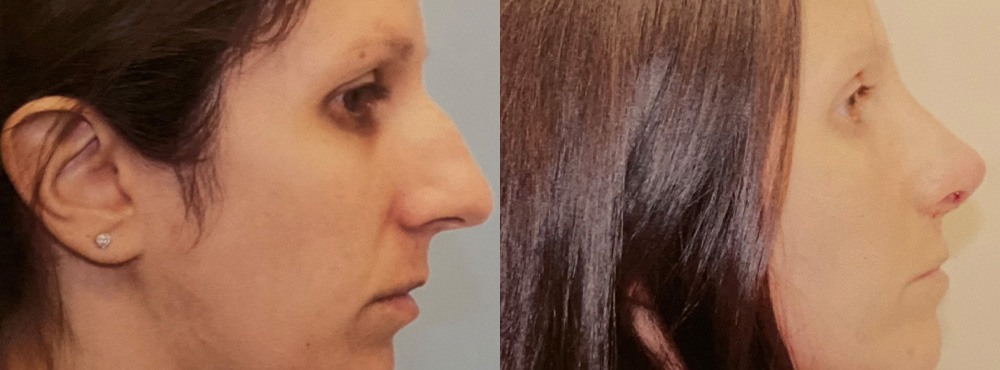 Rhinoplasty Before and After