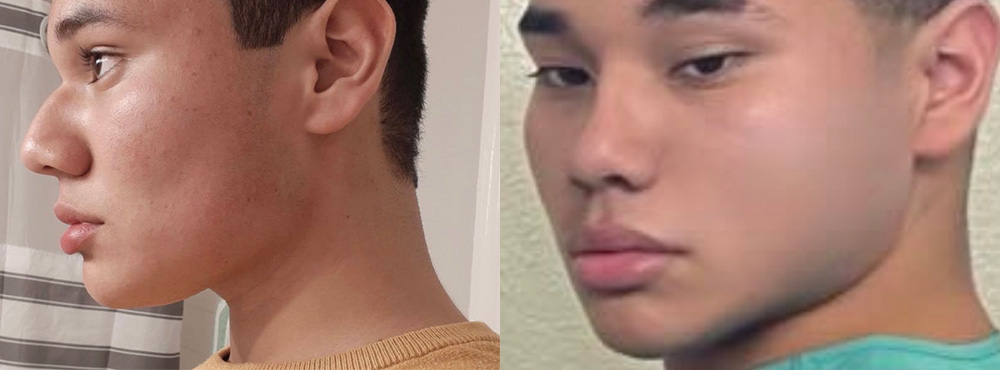 Rhinoplasty Before and After