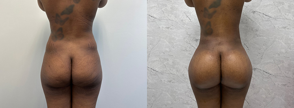 BBL Before and After