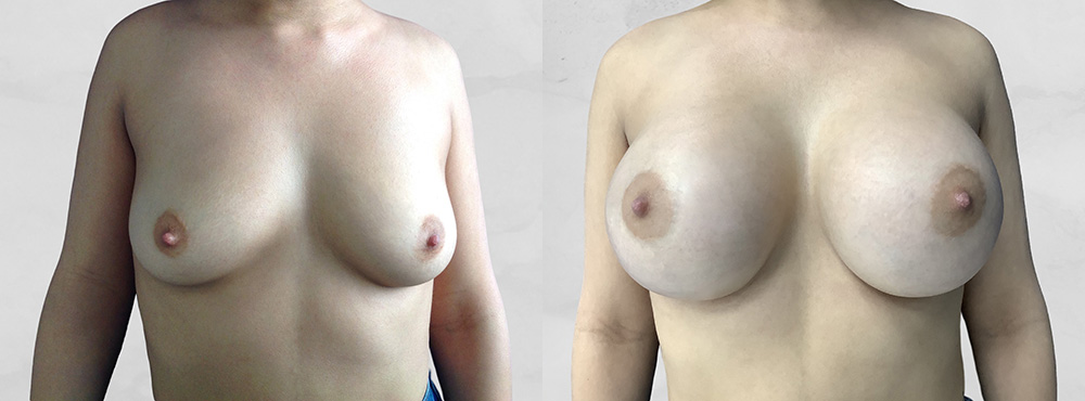 Breast Augmentation Before and After