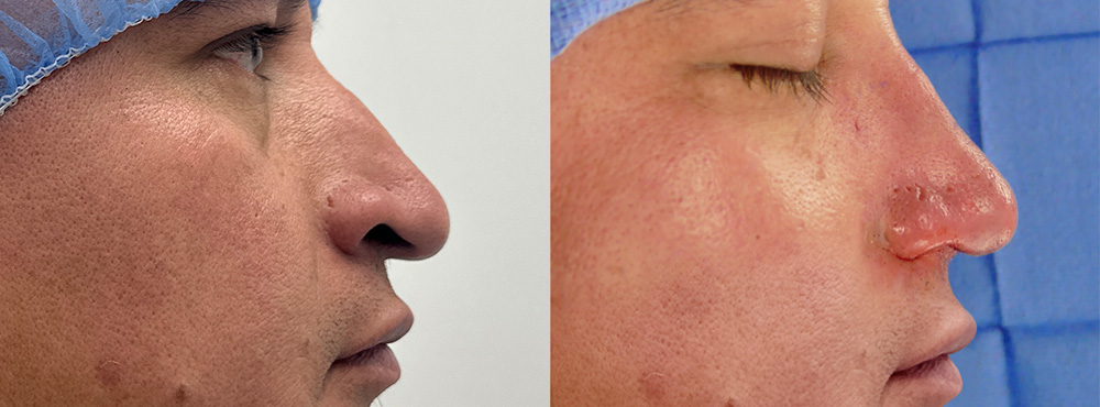 Rhinoplasty in Miami Before And After