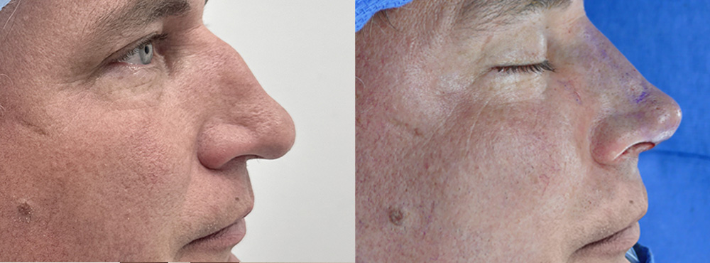 Rhinoplasty in Miami Before And After