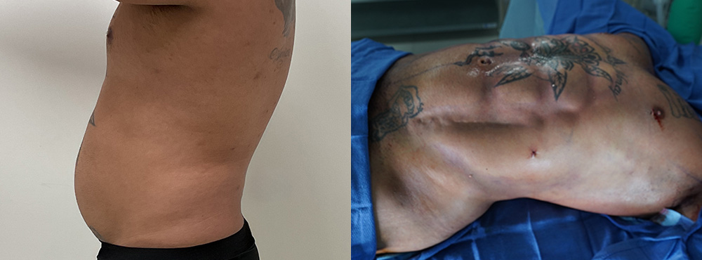 Abdominal Etching before and after in miami