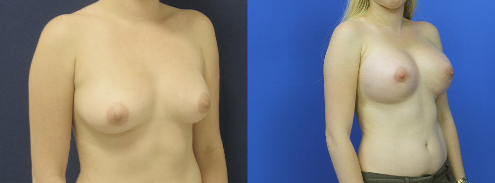 Breast Augmentation Before and After