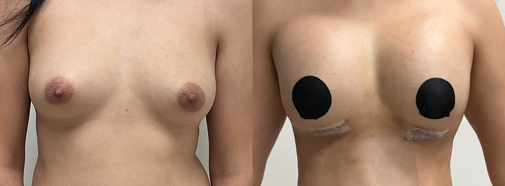 Breast Augmentation before and after