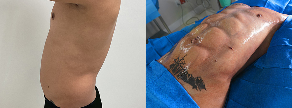Abdominal Etching Before and After in Miami