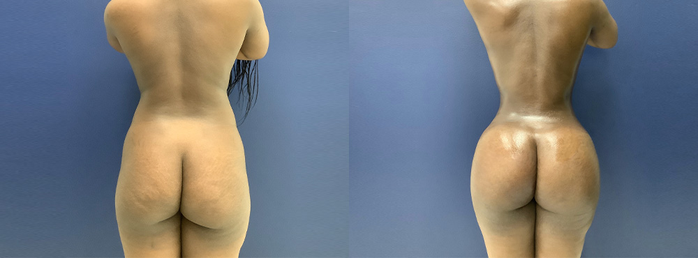 BBL Before and After