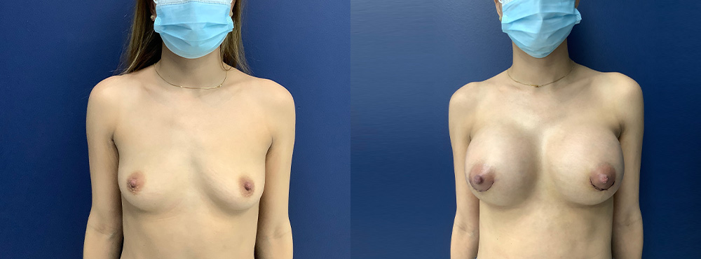 Breast Augmentation Before and After