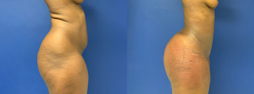 Brazilian Butt Lift Before and After