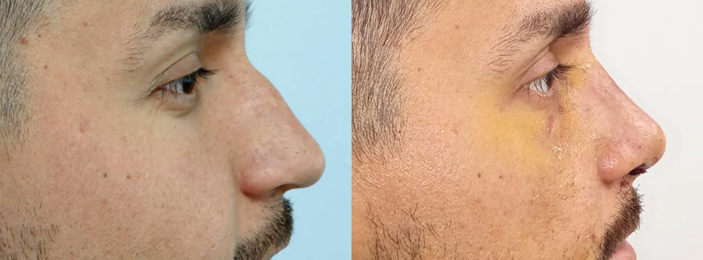 Rhinoplasty Before And After in Miami