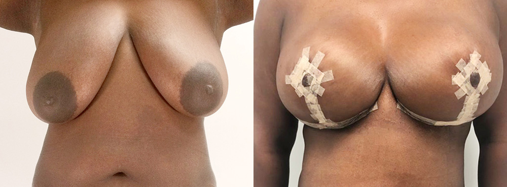 Breast Lift Before and After