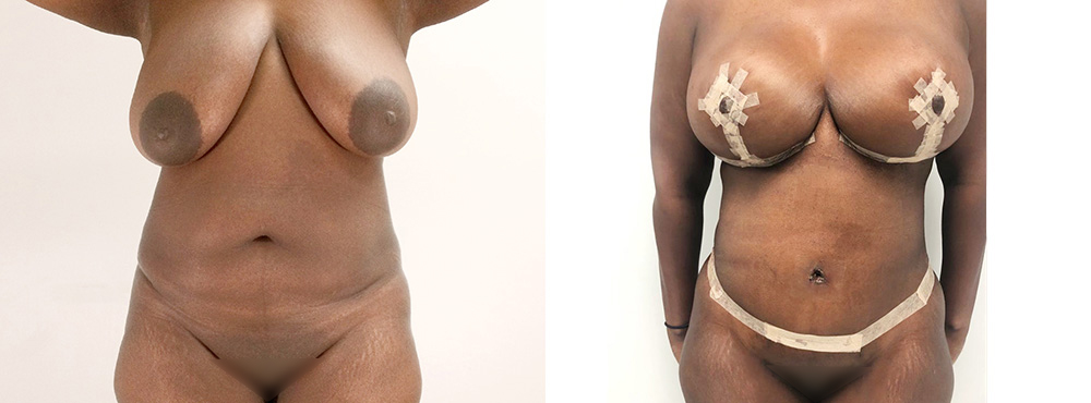 Mommy Makeover Before and After