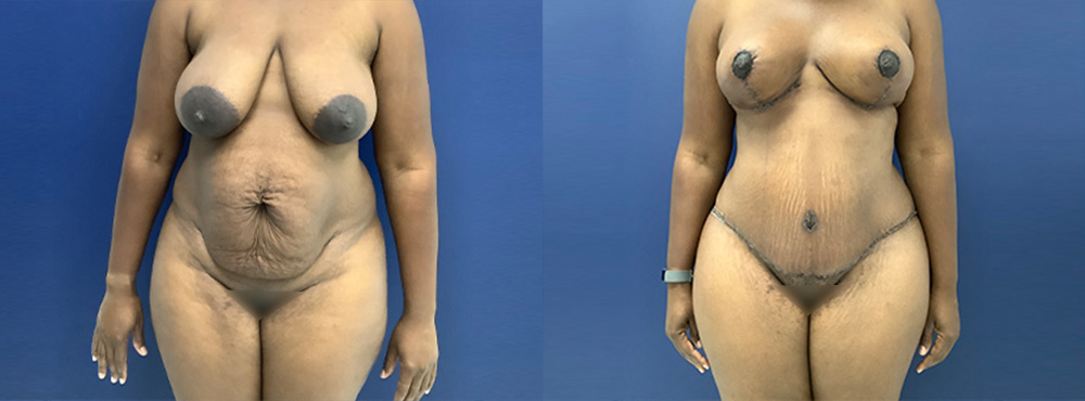 MMO Before and After