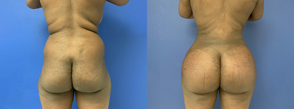 Brazilian Butt Lift Before and After