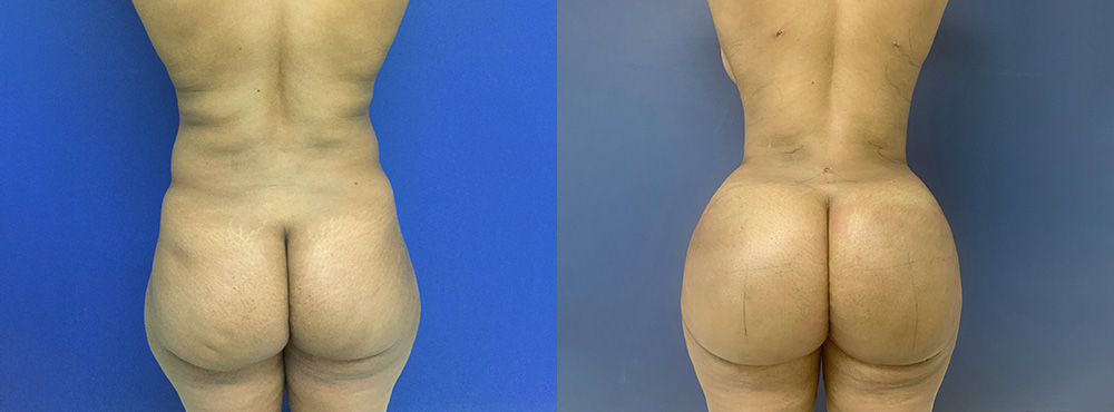 Brazilian Butt Lift Before and After