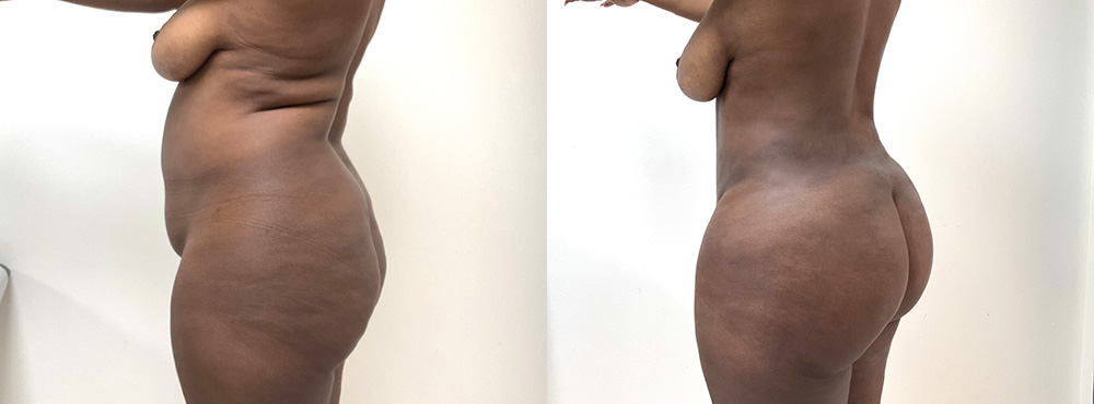 Brazilian Butt Lift Before and After