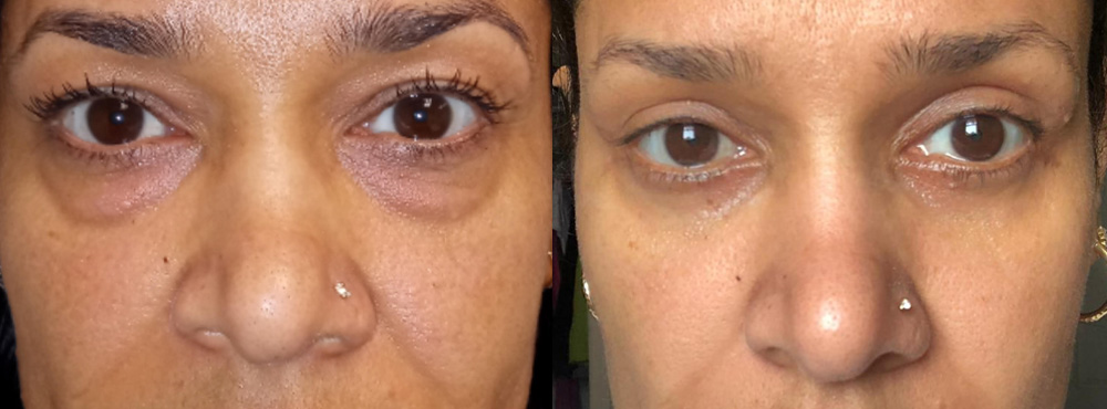 Blepharoplasty Before And After in Miami
