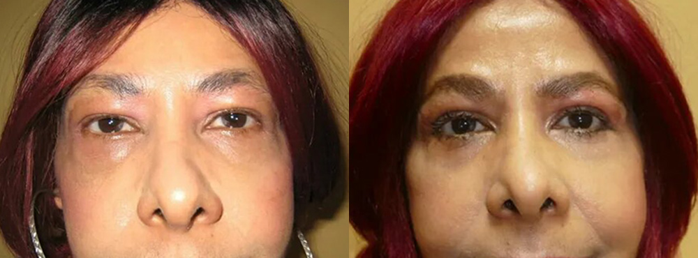 Blepharoplasty Before and After