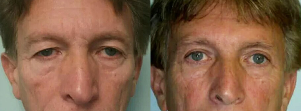Blepharoplasty Before and After