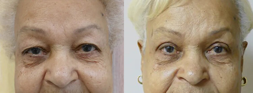 Blepharoplasty Before and After