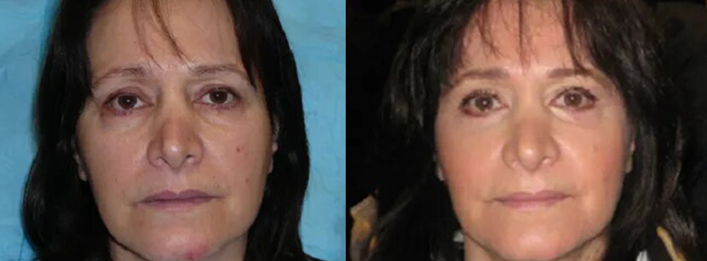 Face Lift Before and After