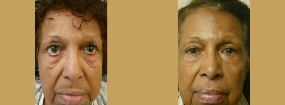 Face Lift in Miami Before And After