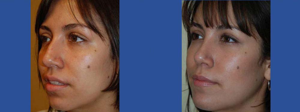 Rhinoplasty Before and After