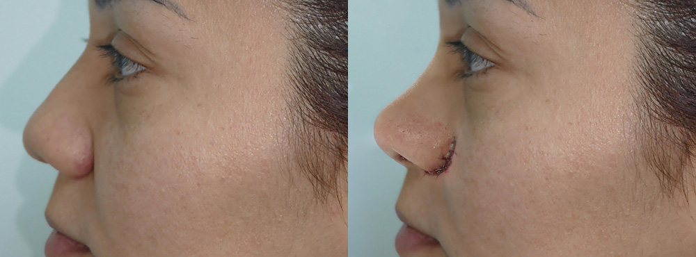 Rhinoplasty Before And After in Miami