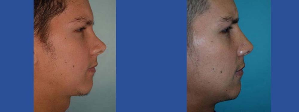 Rhinoplasty before and after