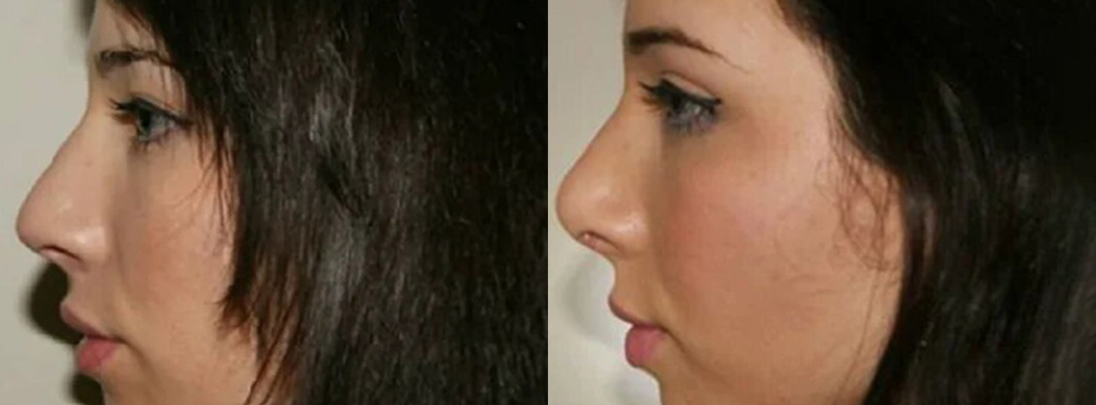 Rhinoplasty Before and After