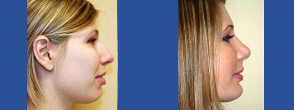 Rhinoplasty Before And After in Miami