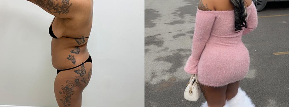 Brazilian Butt Lift before and After