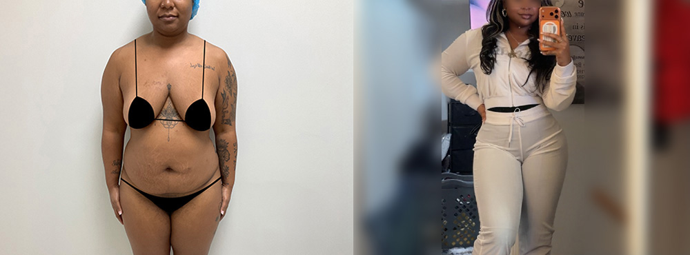 Brazilian Butt Lift before and After