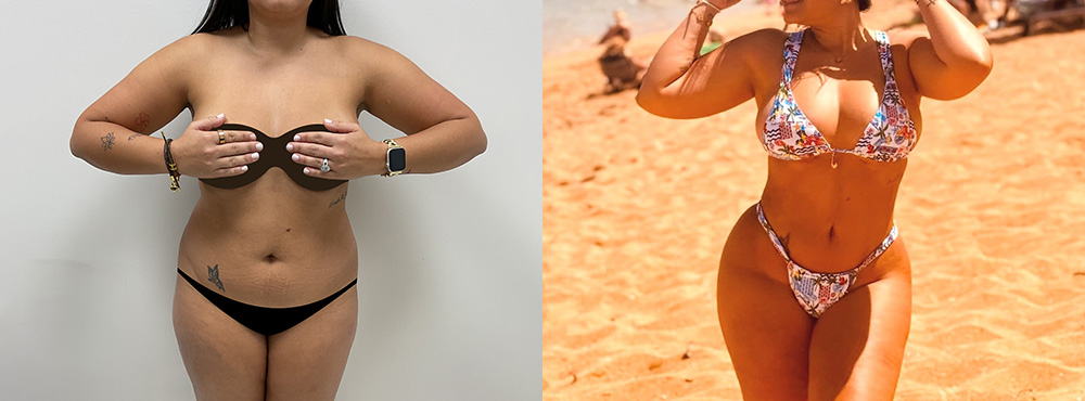 Butt Lift Before and After