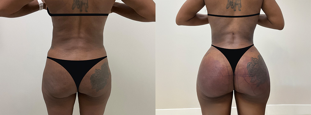 Brazilian Butt Lift before and after