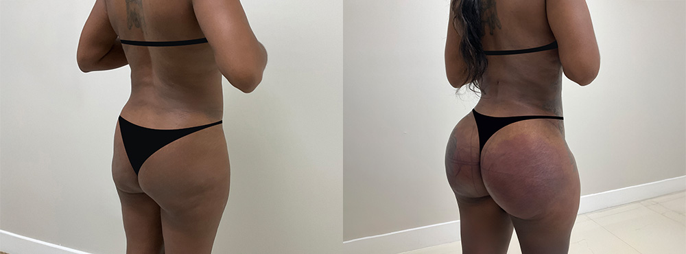 Brazilian Butt Lift before and after